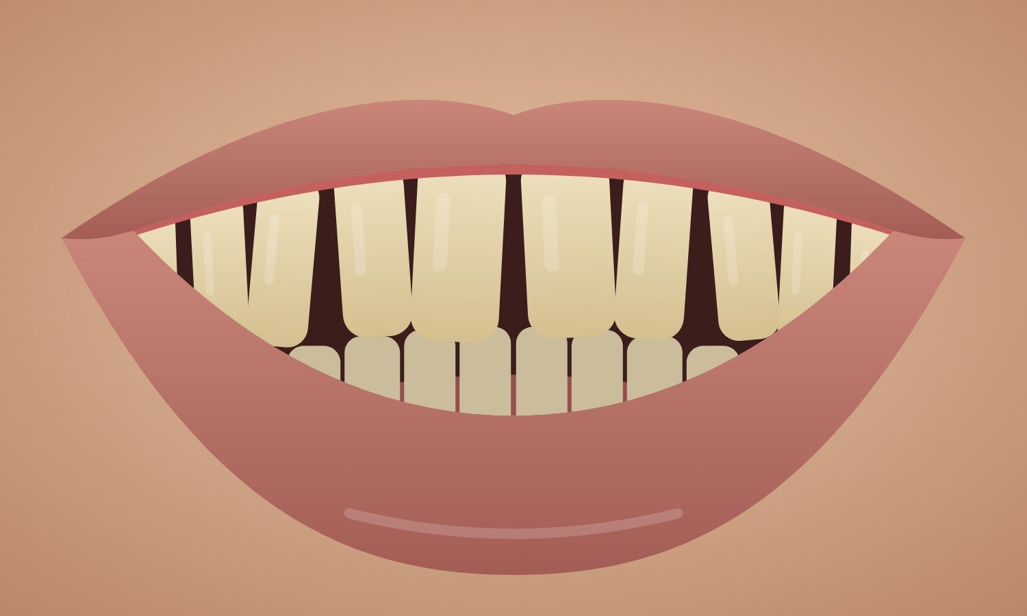 Before: gapped, uneven, yellowed teeth
